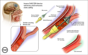Medical illustration revealing how the SHELTER device traps and removes blood clots in the brain.
