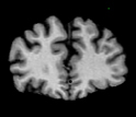 MRI scan of a 79 year-old male human brain.