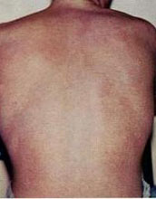 Bare back of a man showing rash seen in people with dengue fever.