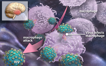 This illustration depicts white blood cells swarming to attack HIV in the brain
