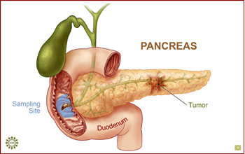 Illustration showing the pancreatic duct, duodenum, sampling site and tumor