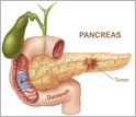 Illustration showing the pancreatic duct, duodenum, sampling site and tumor.