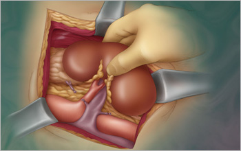 A depiction of kidney harvesting as seen in a live donor transplant.