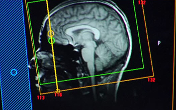 MRI brain image