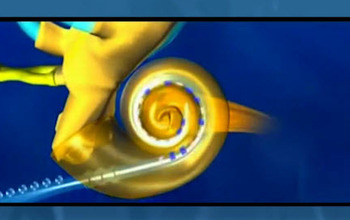Illustration of cochlear implant