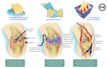 Illustration of ultrasound technology relieving pain and swelling in a knee with osteoarthritis.