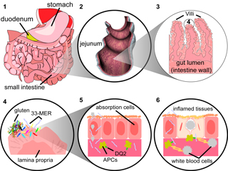 a step-by-step progression of celiac sprue within a patient's intestine; caption is below