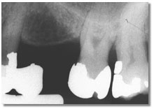 ADIS match x-rays of the same teeth at a different angle