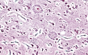 Microscopic image of senile plaques seen in the cerebral cortex of a person with Alzheimer's