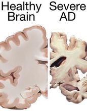 healthy brain compared to a brain suffering from Alzheimer's disease