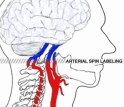 Arterial spin labeling uses an fMRI magnet to "tag" water molecules in the patient's blood