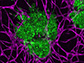 3D bioprinted breast cancer tumors (green)