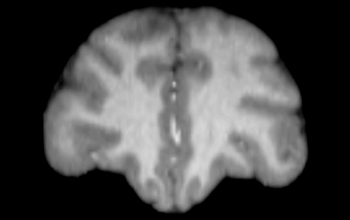 MRI scan of a 15 year-old male chimpanzee brain.