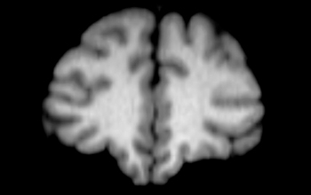 MRI scan of a 42 year-old male chimpanzee brain.