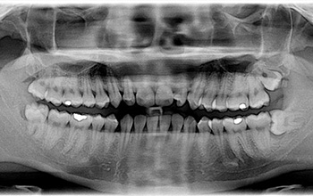 x-ray of teeth