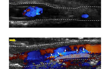 Researchers developed particles that target blood clots and visualize their structures