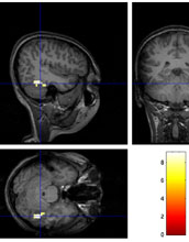 Brain region that is key to facial discrimination