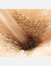 When compressed and pulled, the epidermal electronics device conforms with the skin.