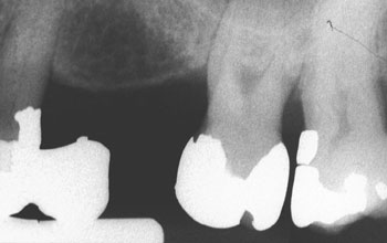 X-ray image of teeth at different angle