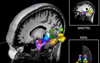 CT scan of human brain