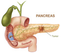 Cancerous pancreas shown with duodenum