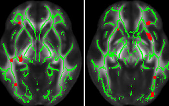 MRI showing deterioration of white matter tracts in the brains of older adults