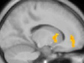 saggital fMRI view of the brain