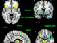 brain scans from the study