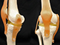 custom menisci for a model of a knee