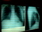 x-ray of pneumonia