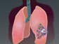 Illustration showing lungs with TB bacteria