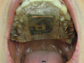 tongue drive system embedded in a dental retainer